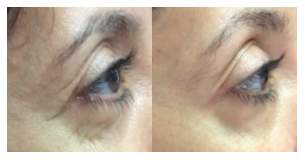 Before & Post 3 Treatments Before & Post 3 Treatments