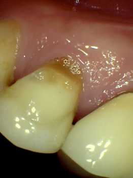 before photo of very common gumline recession where the dark tooth roots show 