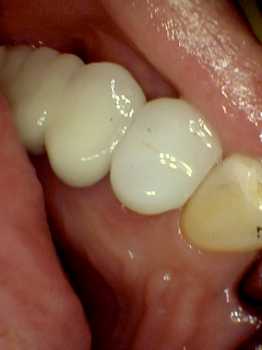 after photo of a white porcelain crown that replaced the large silver filling