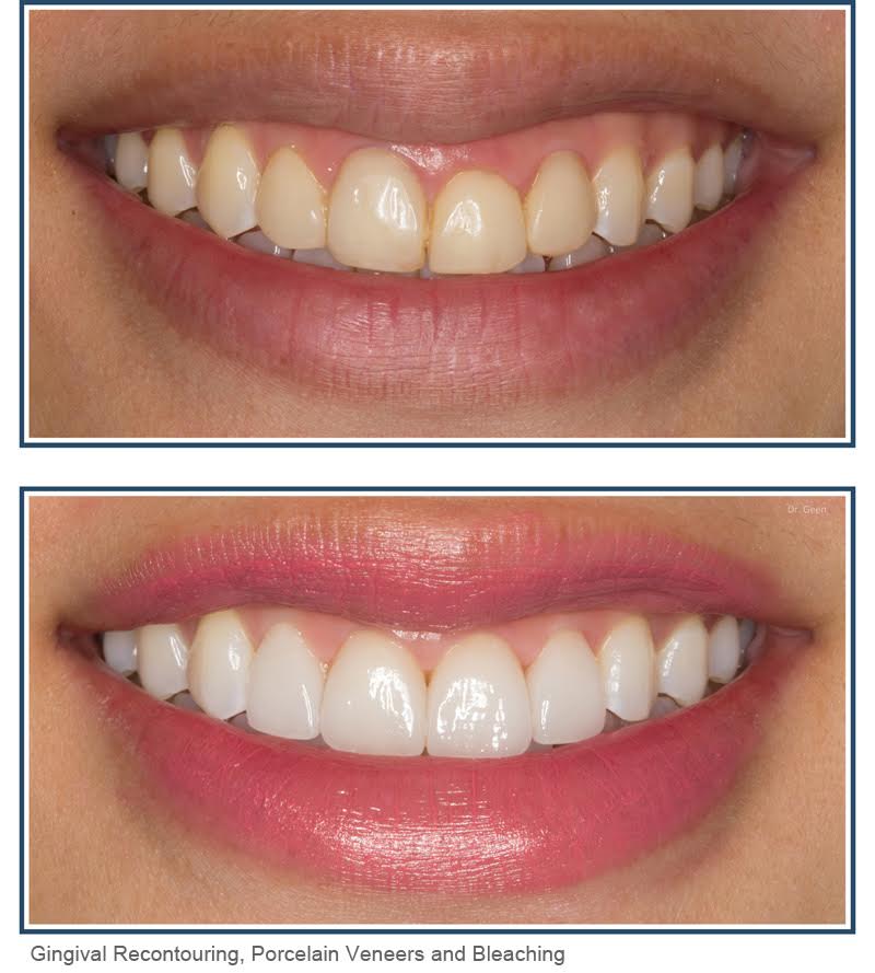 gingival contouring