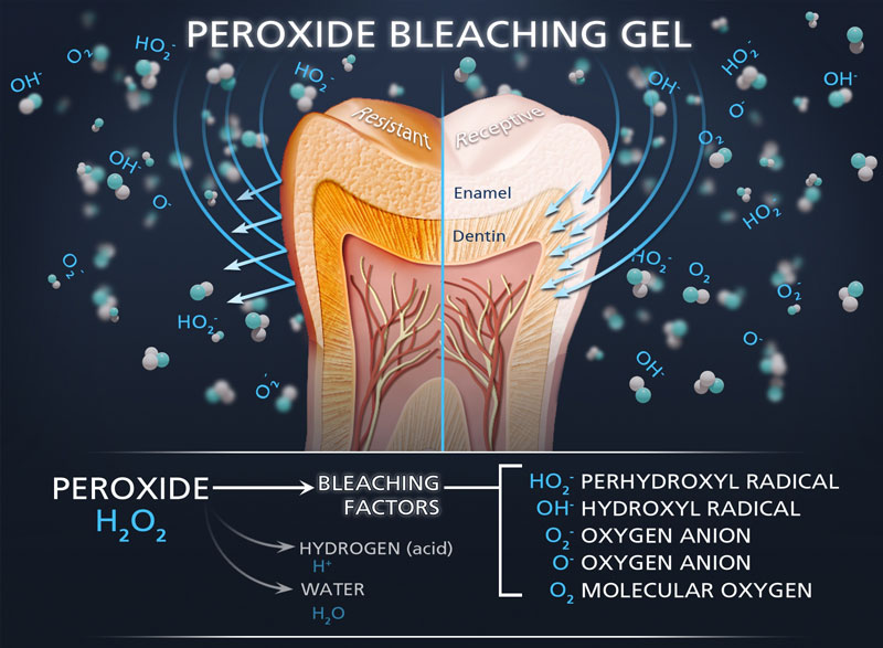 Peroxide Bleaching Gel