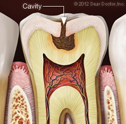 Cavity and Fillings in Norfolk, MA