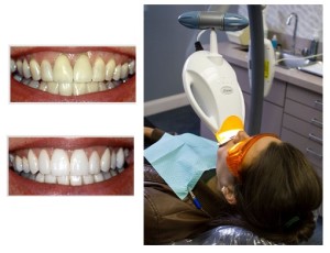 ZOOM Teeth Whitening Image