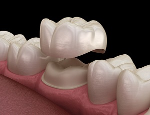 dental crowns in stafford va