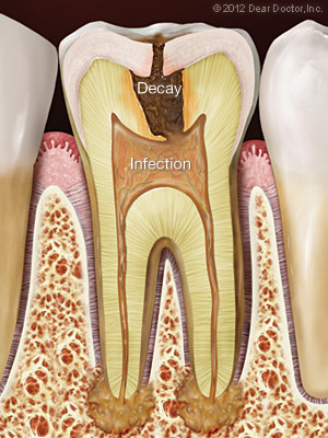root canals in Windsor Locks, CT