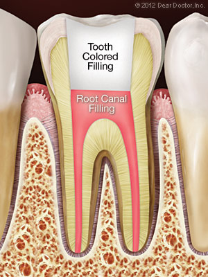 filling after root canal in Windsor Locks, CT