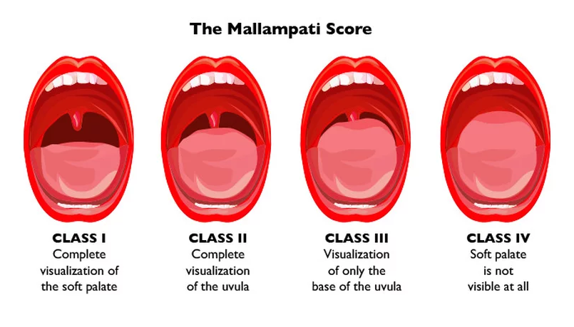 Mallampati Score