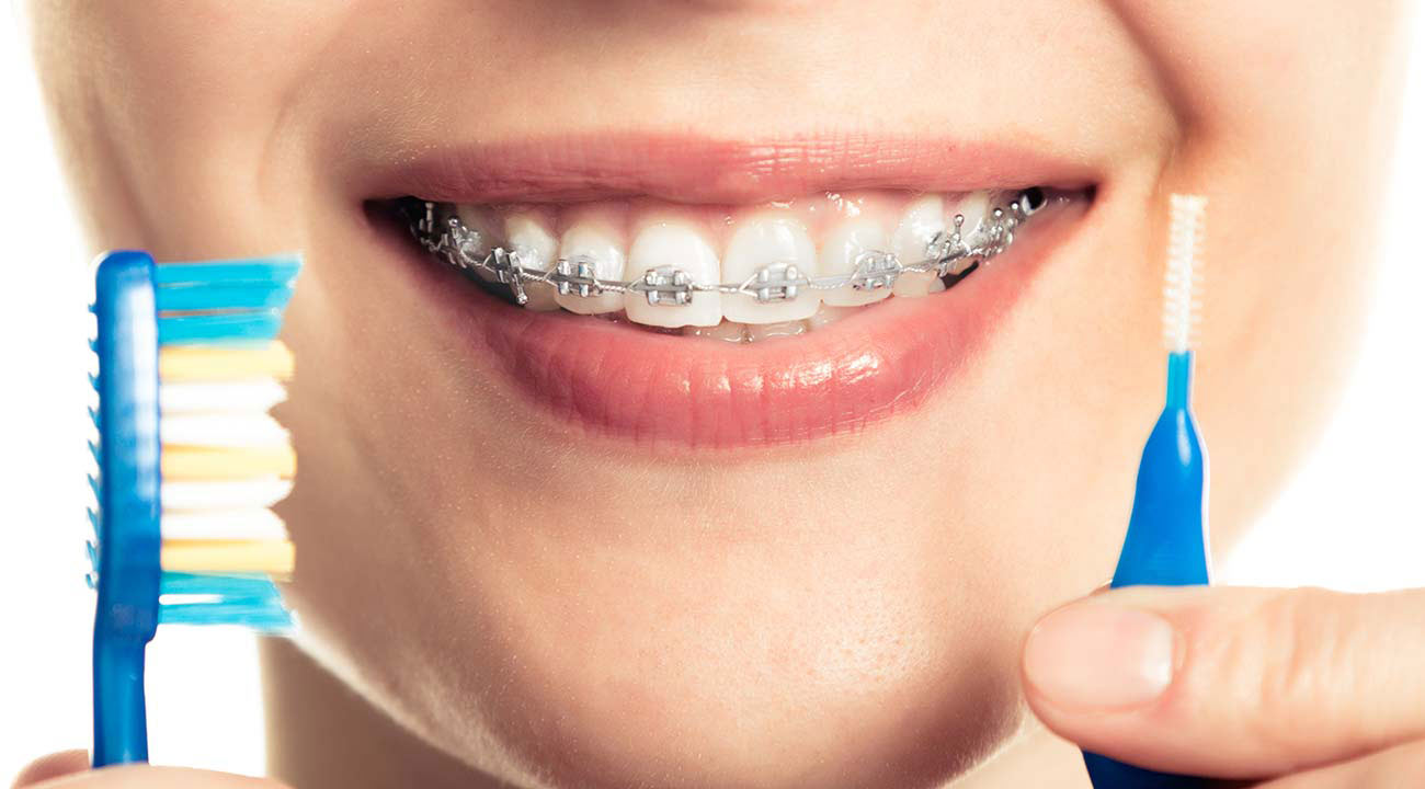 Braces | Dentist in Wayland, Bath, Naples, Dansville and Hornell, NY | Deborah L. Schafer, DDS