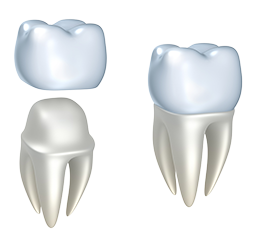 illustration of crown being placed over prepared tooth, dental crowns Charlotte, NC dentist