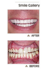 Dental Implants - Lexington MA - Prosthodontist - Dentist