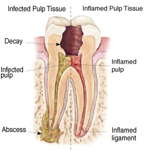 endodontic