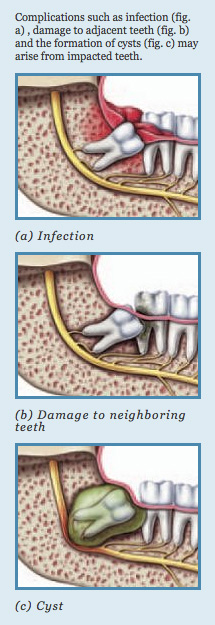 infection