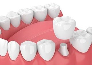 3D illustration of teeth and gums with dental crown being fitted over prepared tooth, dentist Frederick, MD general dentistry 