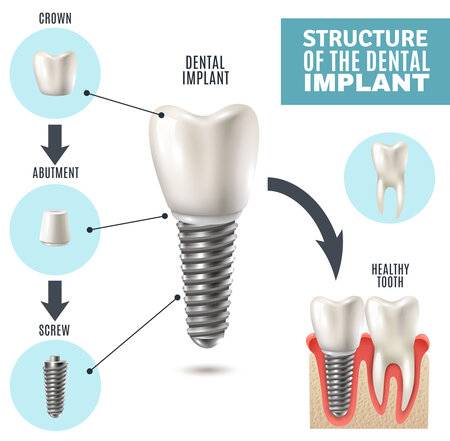 "Structure of the Dental Implant" illustrated diagram showing implant parts and assembly, dental implants Frederick, MD dentist 