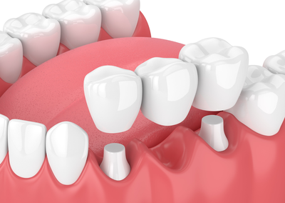 3D illustration of teeth and gums with dental bridge being placed over abutment teeth, family dentist Frederick, MD general dentistry