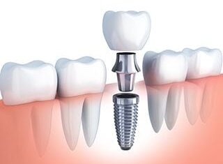 illustration of dental implant parts and assembly in mouth, dental implants Frederick, MD dentist 