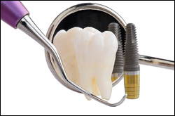 Dental Implants Monroe WA