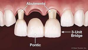 illustration of top row of teeth with 3 unit bridge being placed to replace missing front tooth, dental bridge Harrisburg, PA dentist