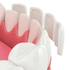 3D illustration of lower teeth, dental veneers floating in front of teeth about to be placed on, veneers Harrisburg dentist