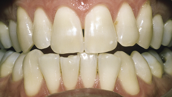 Bleaching - The Dental Practice of Lincoln Park - Chicago, IL