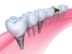 Diagram of how dental implants sit in the jaw in Lincoln Park, IL