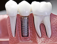 Model jawbone cross section showing a dental implant in Lincoln Park, IL