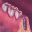 Implants - The Dental Practice of Lincoln Park - Chicago, IL