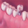 Implants - The Dental Practice of Lincoln Park - Chicago, IL