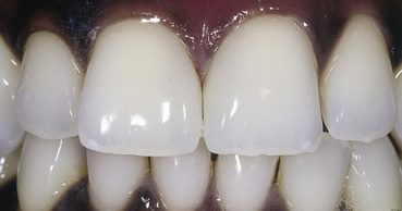 Veneers - The Dental Practice of Lincoln Park - Chicago, IL