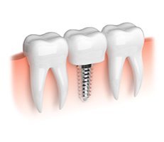 Dental Implant Illustration - Dental Implants in North Austin and South Austin