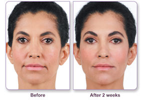 Nasolabial fold & marionette lines treated with dermal fillers