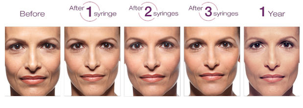 Nasolabial folds & Marionette lines treated with dermal fillers