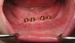 locator implant denture