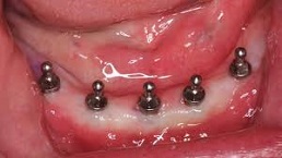 mini implant denture