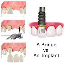bridge vs implant