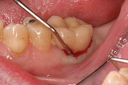 failed dental implant