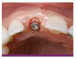 front tooth implant