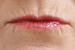 lip augmentation