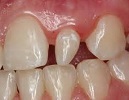 peg lateral incisor