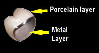 porcelain layer