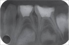 baby root canal