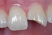 repair chipped tooth