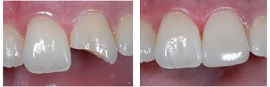 repair chipped tooth