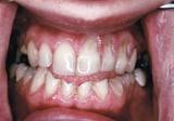 teeth sensitivity