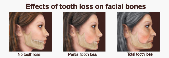 tooth loss