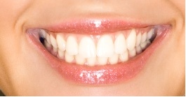 close up of a smile with bonding and white fillings