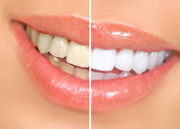 before and after results of teeth whitening Narberth, PA cosmetic dentist