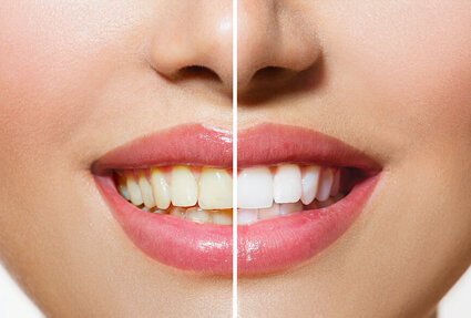 split image of woman's face, showing before and after results of professional teeth whitening Narberth, PA dentist