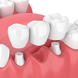 3D illustration of 3-unit dental bridge being placed over abutment teeth to replace missing tooth, cosmetic dentist Narberth, PA