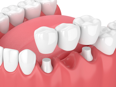 3D illustration of teeth in mouth, dental bridge being placed over abutment teeth, dentist Narberth, PA